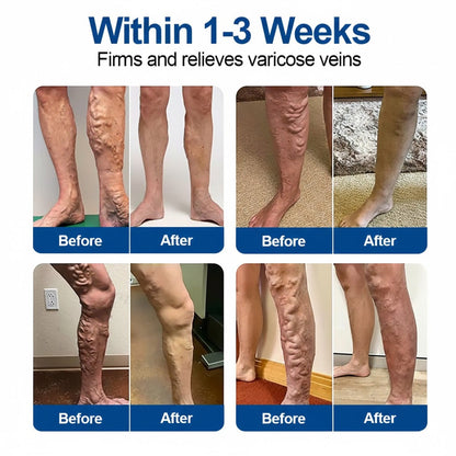 🇦🇺👨‍⚕️✅ Natravor® VeinEase Microneedle Care Patch ⚡ Fast Comfort, Lasting Leg Support